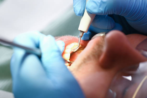 Best Emergency Root Canal Treatment in Anacoco, LA