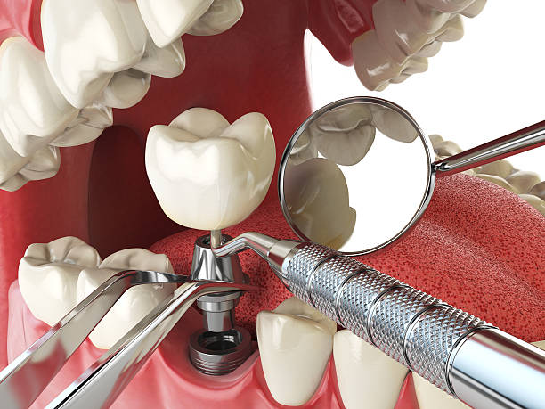 Best Emergency Dentist for Knocked-Out Tooth in Anacoco, LA